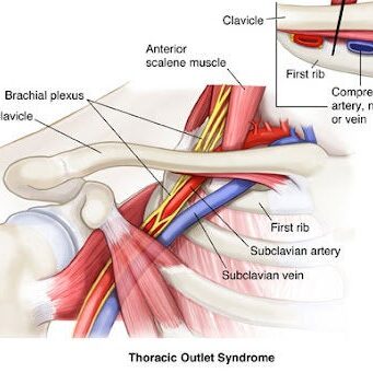 A diagram of the thoracic outlet syndrome.